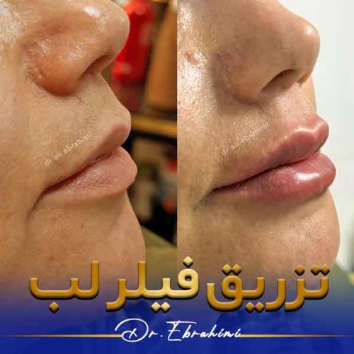 تزریق-فیلر-1
