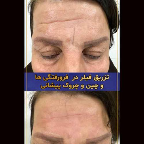 تزریق-فیلر-3