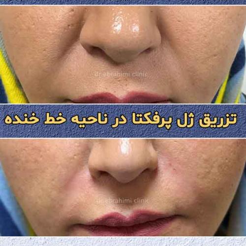 تزریق-فیلر-5
