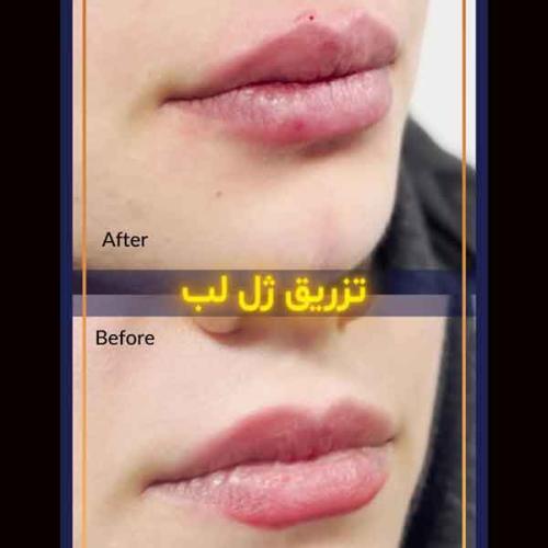 تزریق-فیلر-6