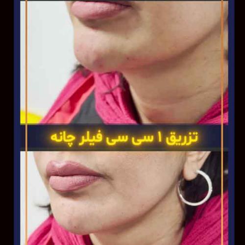 تزریق-فیلر-8