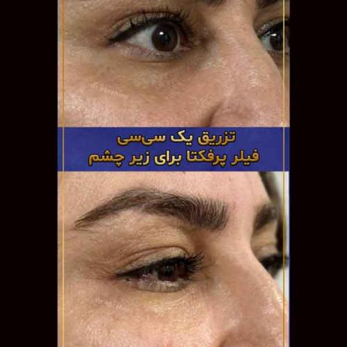 تزریق-فیلر4