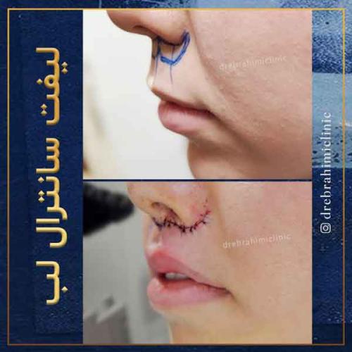 لیفت-سانترال-لب-1
